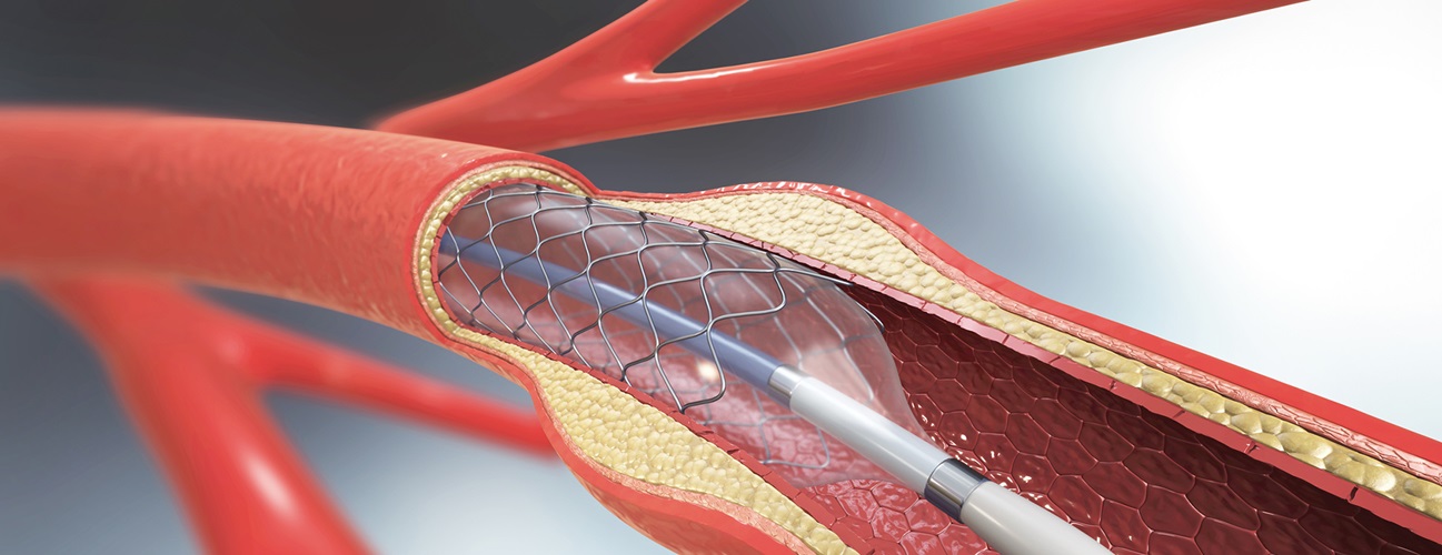 Girişimsel Kardiyoloji İşlemleri (stent, ablasyon)
